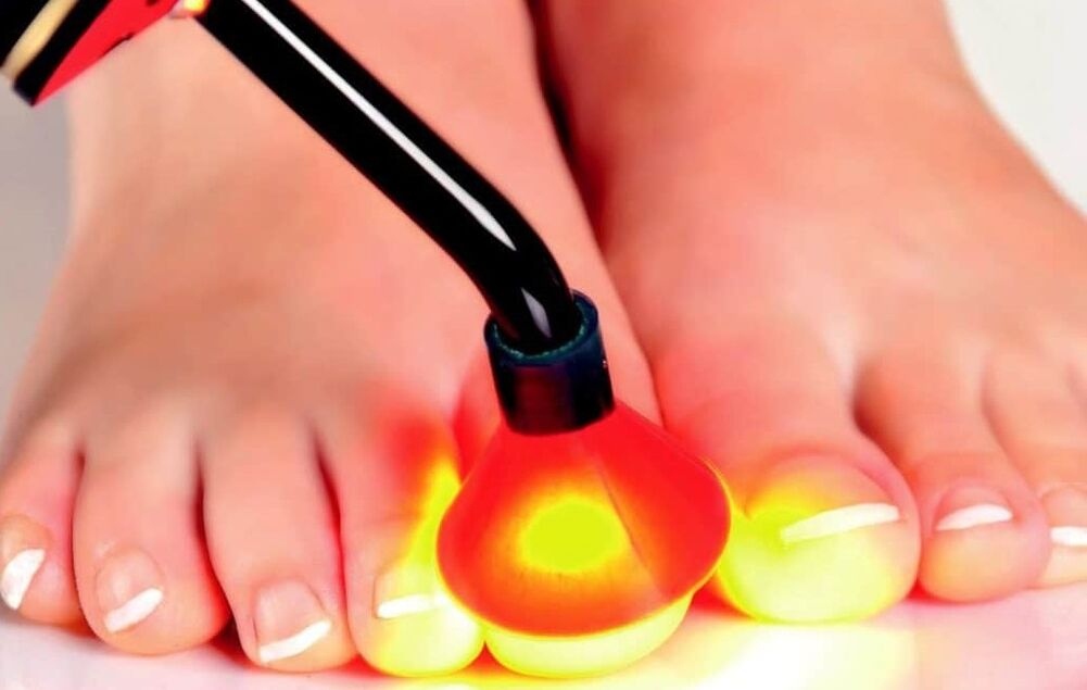 Laserski tretman ploče za nokte
